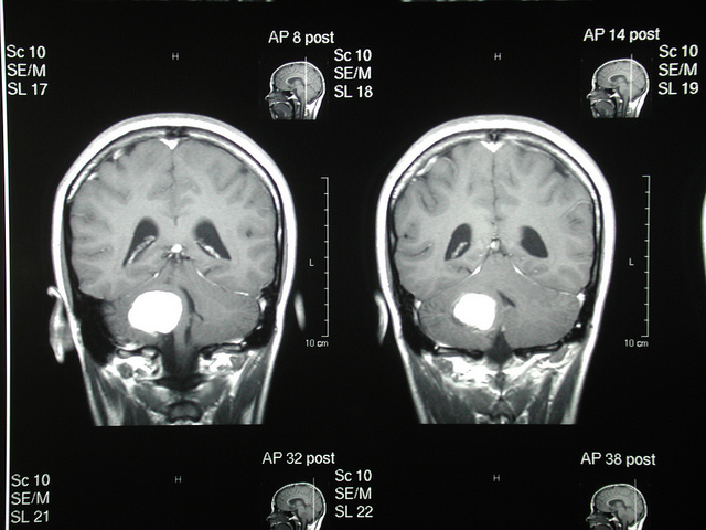 brain_tumor_-_subewl.jpg